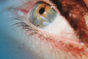 Astigmatismo e laser: quando si può correggere e quando no
