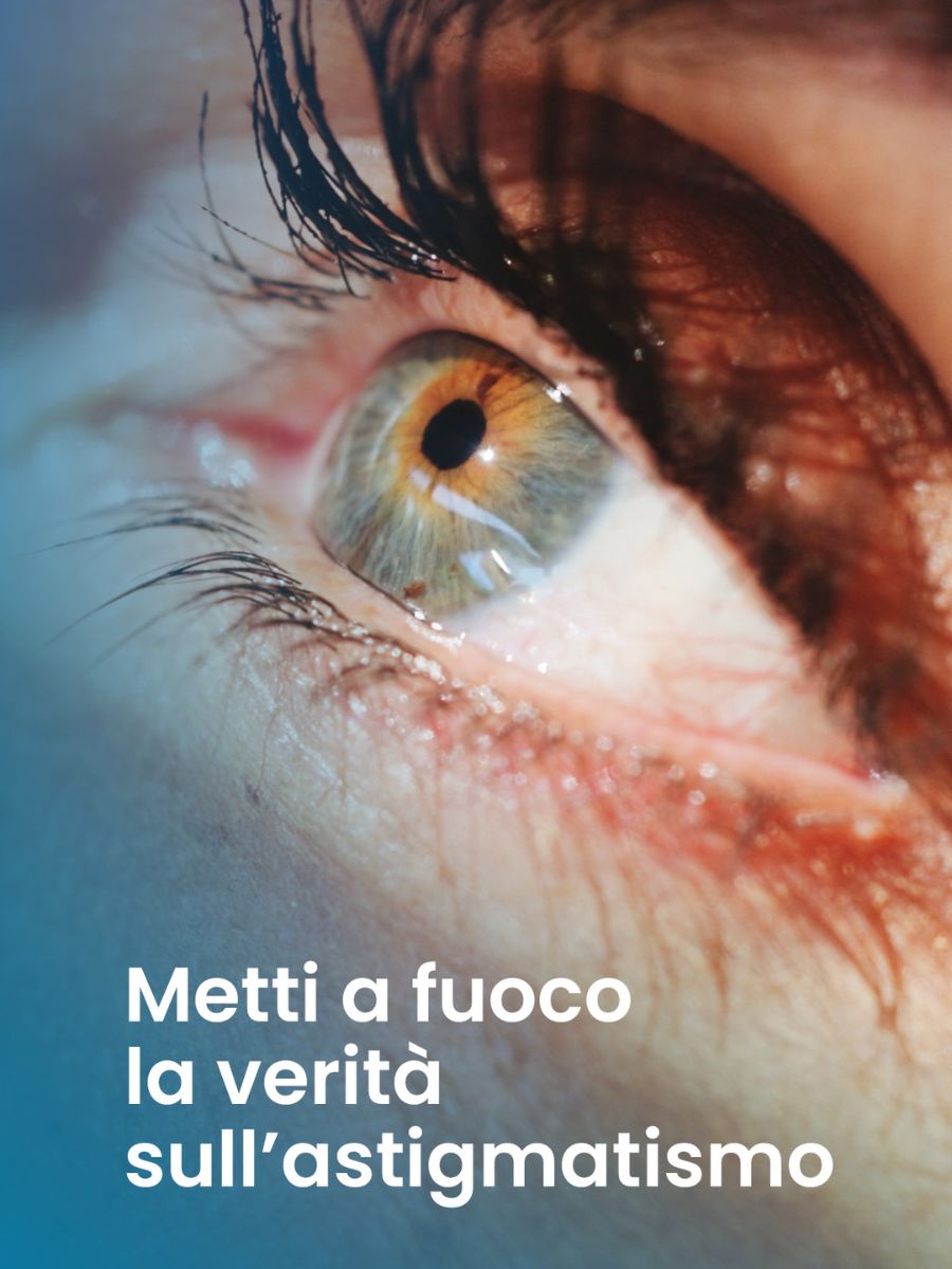 Astigmatismo e laser: quando si può correggere e quando no